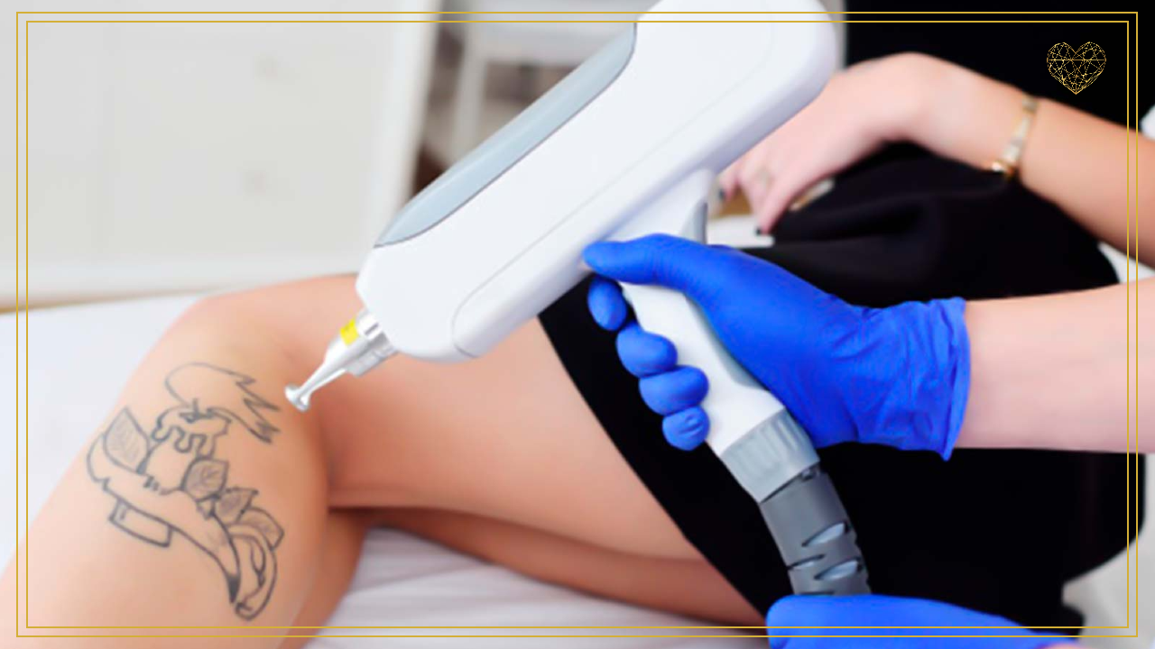 remoción de tatuajes