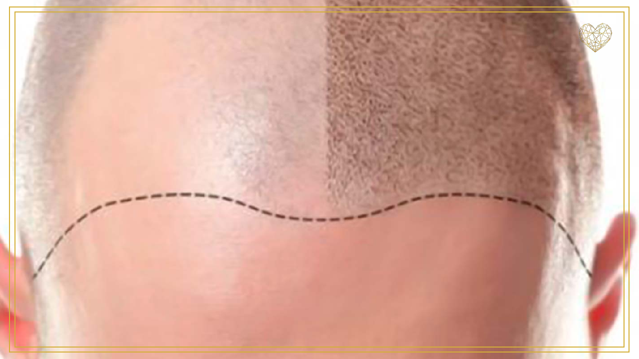 Tricopigmentación