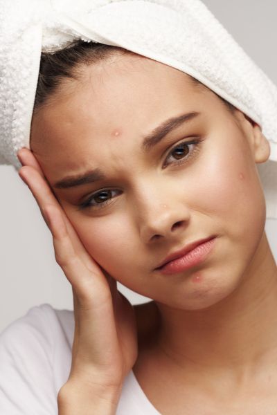 Tratamiento de acné y secuelas